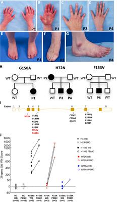 Case Report: Novel SAVI-Causing Variants in STING1 Expand the Clinical Disease Spectrum and Suggest a Refined Model of STING Activation